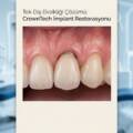 Tek Diş Eksikliği ve CrownTech İmplant Çözümleri: Geleceğin Gülüşünü Bugünden İnşa Edin